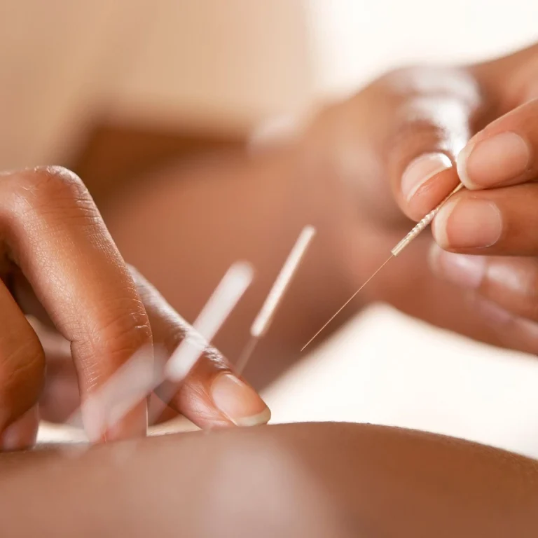Acupuncture